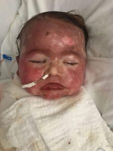 Read more about the article Baby Who Suffered Rash To 72 Percent Of Body Following Allergic Reaction Finally Discharged From Hospital After 46 Days