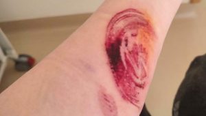 Read more about the article Volkswagen Logo From Airbag Flap Burned Into Accident Victims Arm
