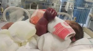 Read more about the article Newborn Babys Arm Swells Up And Turns Purple After Mum Uses Elastic Band To Hold Up Sleeve