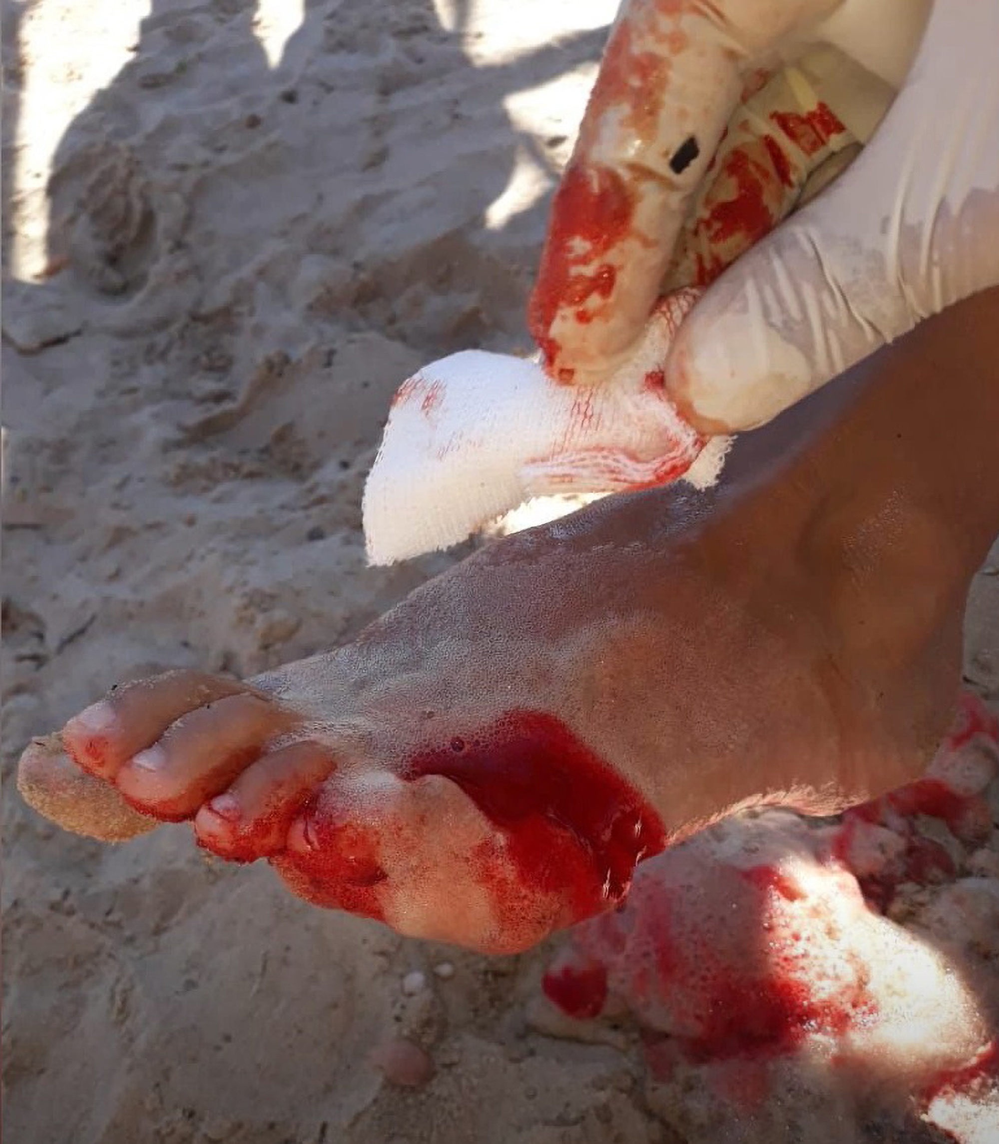 Read more about the article Teenage Girl Loses A Toe In Attack By Piranhas That Left 20 Injured