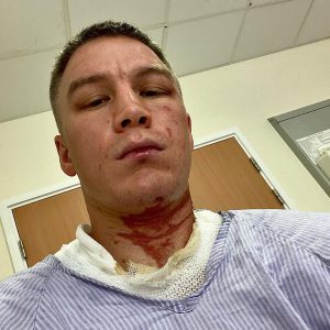 Read more about the article Kazakh Boxer Attacked In UK By Hooded Thugs Who Doused Him With Acid In Middle Of Night