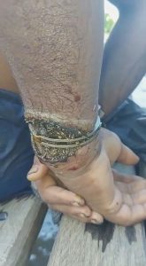 Read more about the article Handcuffed Man Found With Scores Of Maggots Wriggling In Massive Wrist Wound