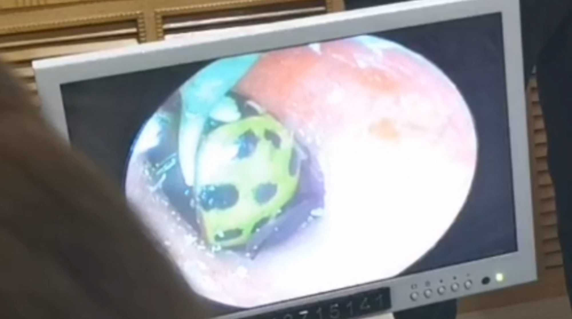 Read more about the article Doctor Removes Ladybird From Inside Young Boys Ear