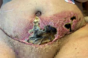 Read more about the article Cops Investigate Plastic Surgeon For Leaving Patients With These Horrifiying Injuries