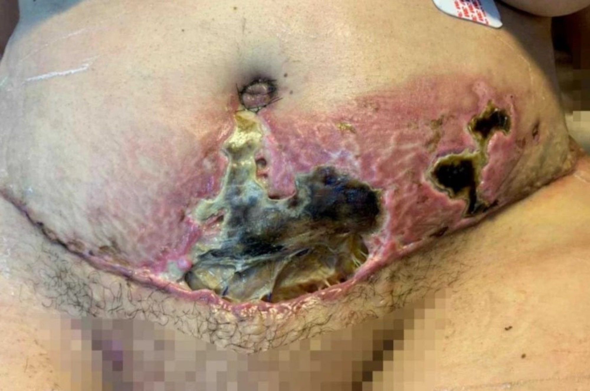 Read more about the article Cops Investigate Plastic Surgeon For Leaving Patients With These Horrifiying Injuries