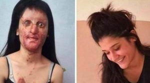 Read more about the article Woman Marries Man Who Threw Acid On Her Face, Leaving Her Disfigured And Almost Blind