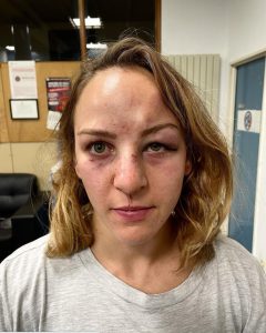 Read more about the article Blonde Olympic Judo Champ Claims Coach Lover Beat Her And Smashed Her Head Against The Floor