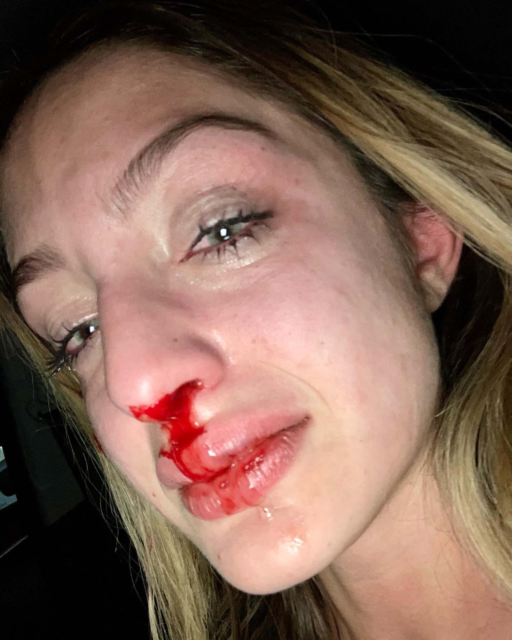 Read more about the article Venezuelan Model Takes To Insta To Show Horrific Injuries Caused By Her Violent Ex And Urges Other Victims To Come Forward