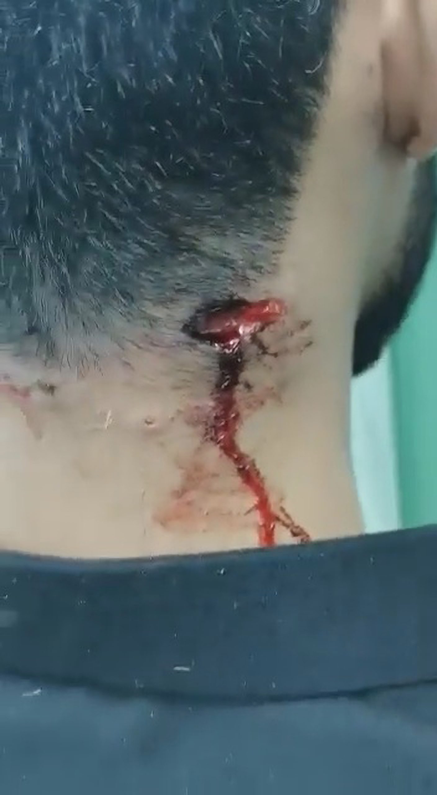 Read more about the article Man Survives Wolf Attack With Massive Bite Mark On His Neck