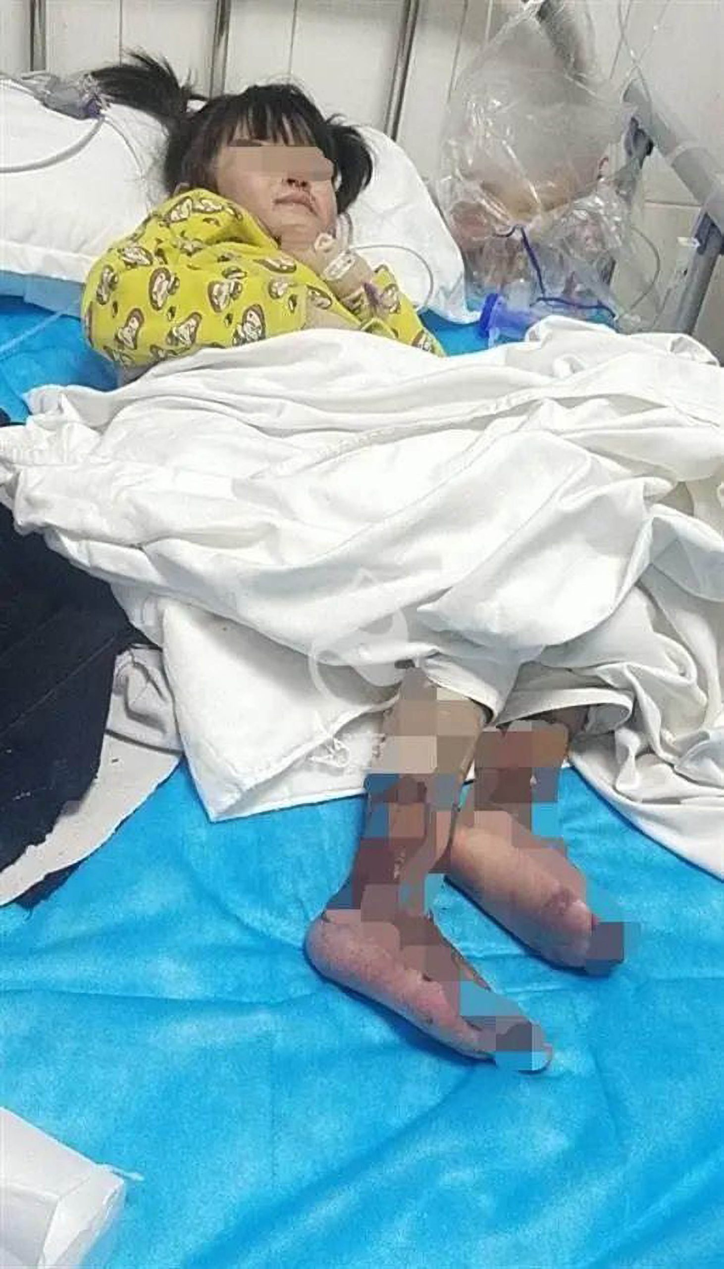 Read more about the article Girl, 4, Narrowly Avoids Having Both Legs Amputated After Stepmum Burns Her With Boiling Water