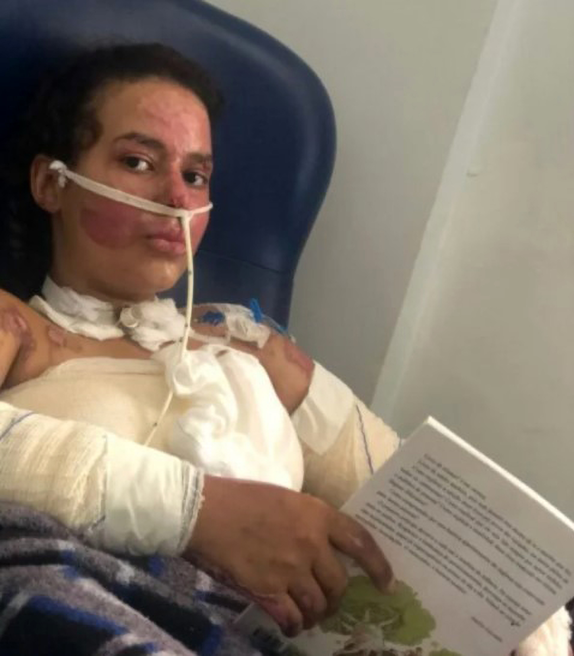 Read more about the article New Photos Show Pretty Teen Who Was Badly Burnt In Bungled Science Experiment Covered In Bandages In Hospital