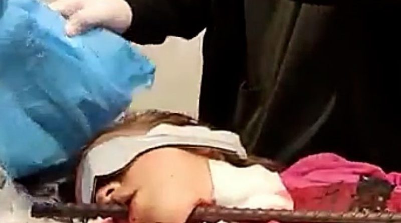 Young Girl Impaled By Iron Bar Through Throat And Mouth Survives And Can Now Go Home