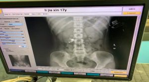 Read more about the article Wireless Earbud Found In Stomach Of Woman Who Fell Asleep Listening To Music And Dreamed She Was Eating Something