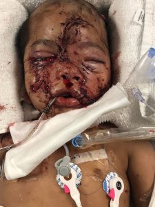 Read more about the article Boy, 1, In Critical Condition After Being Viciously Mauled By 5 Pit Bulls That Ripped His Face Apart