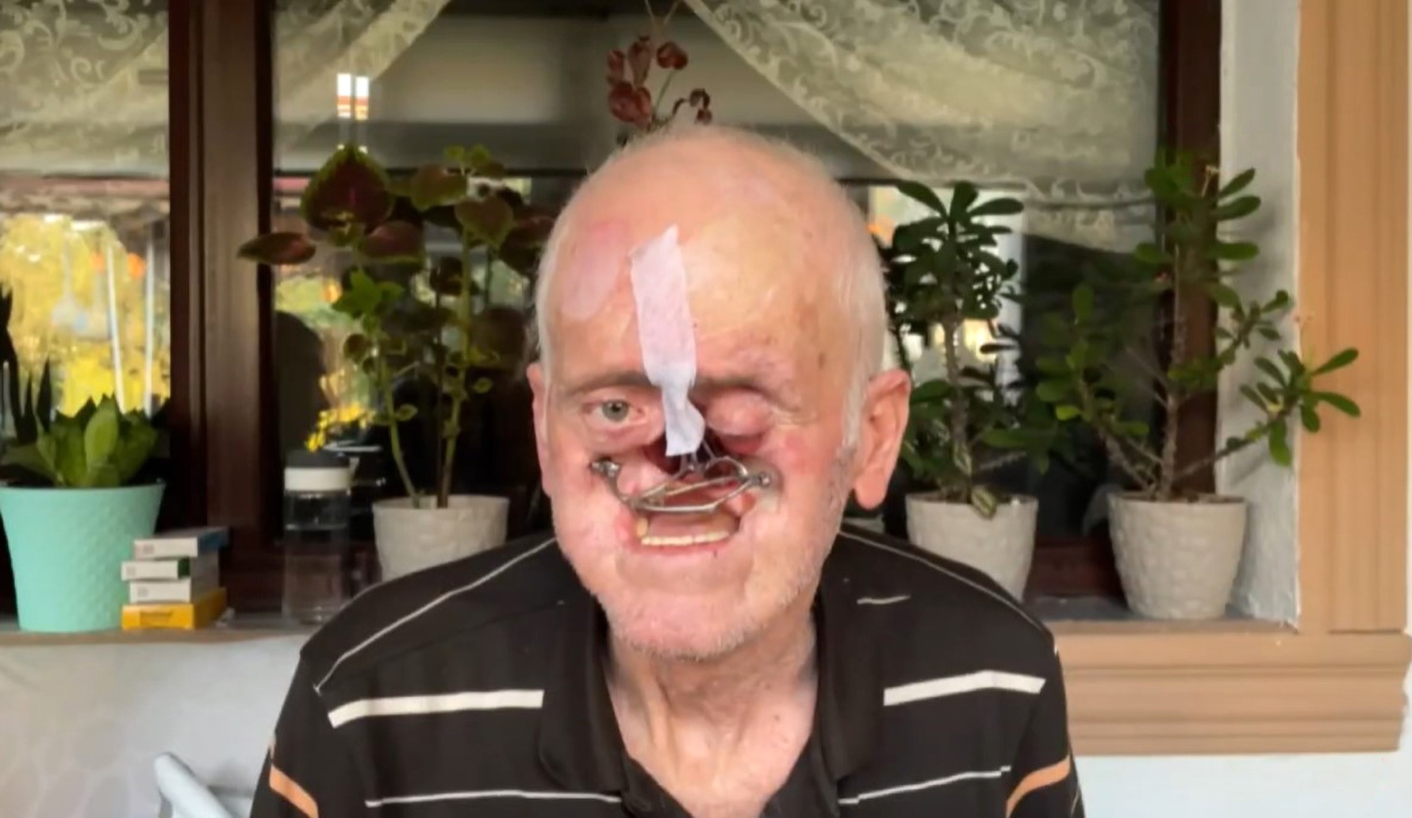 Read more about the article Man Has Gaping Hole In Face After Cancerous Pimple Eats His Nose