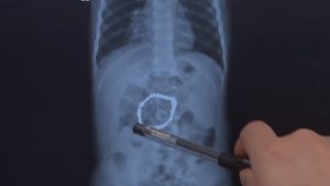 Read more about the article Docs Discovers 32 Metal Beads Inside Tots Tummy That Could Have Punctured Gut After Parents Took Sibling To Hospital Over Cough