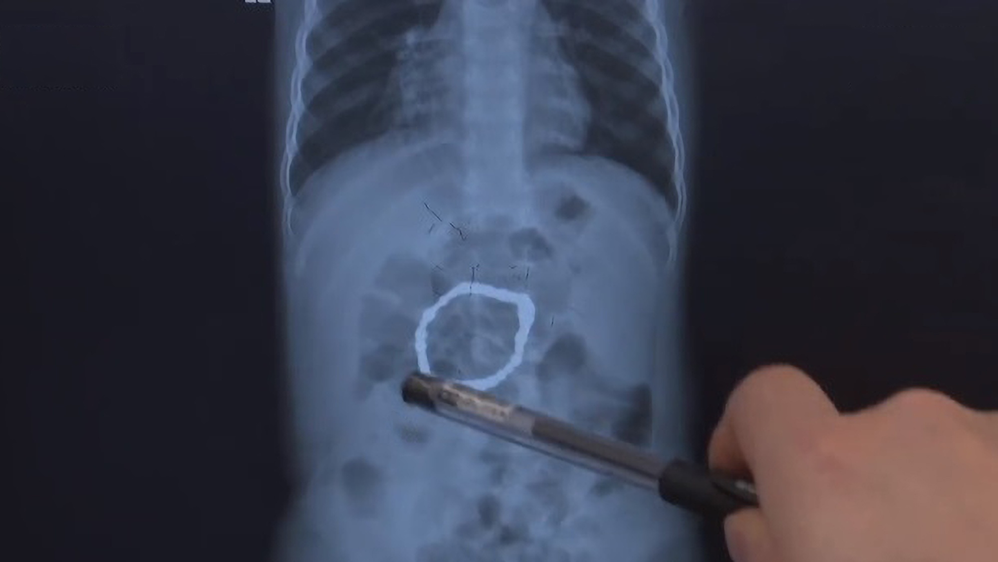 Read more about the article Docs Discovers 32 Metal Beads Inside Tots Tummy That Could Have Punctured Gut After Parents Took Sibling To Hospital Over Cough