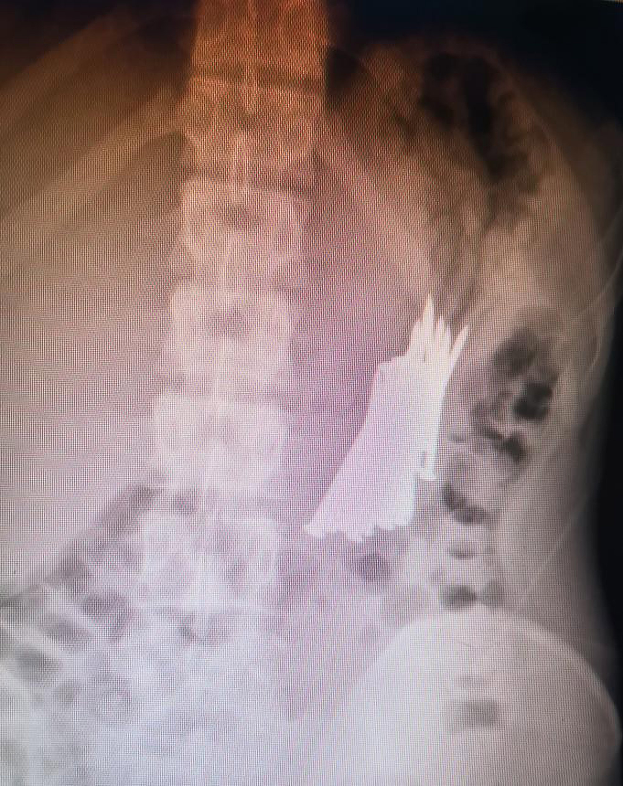 Read more about the article Chinese Man Has 36 Metal Nails Removed From Gut After Swallowing Them In Bad Mood
