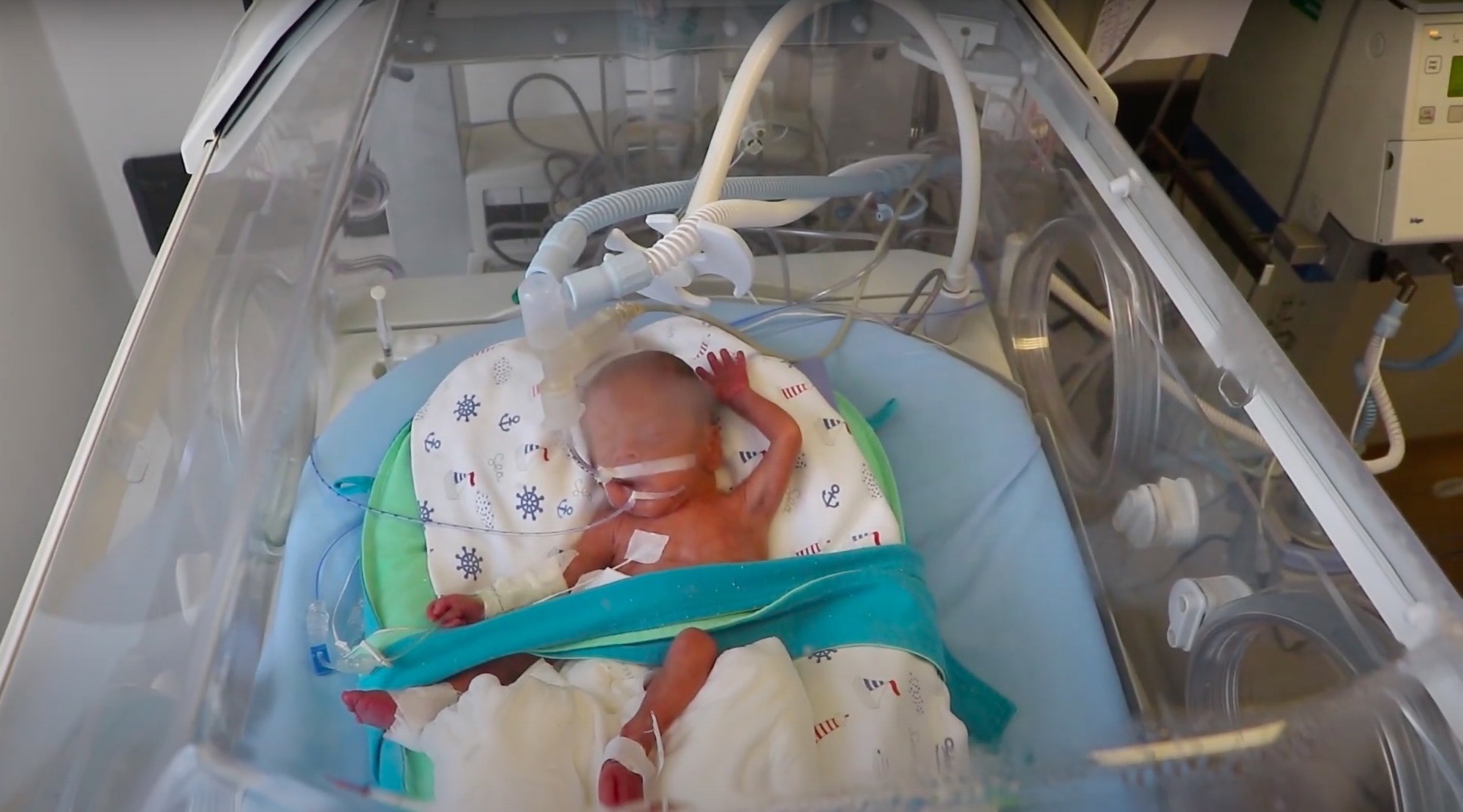 Read more about the article Doctors Carry Out Rare Cutting Edge Umbilical Cord Stem Cell Transplant Surgery To Help Premature Baby Boy Grow Lungs
