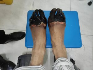 Read more about the article YOUR FEET ARE TOE-ST: Woman Stuck On Mountain For Three Days Loses Toes To Frostbite