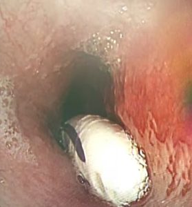 Read more about the article BRUSH OFF: Woman Swallows 18cm Toothbrush And Asks For Medical Help Only 7 Hours Later