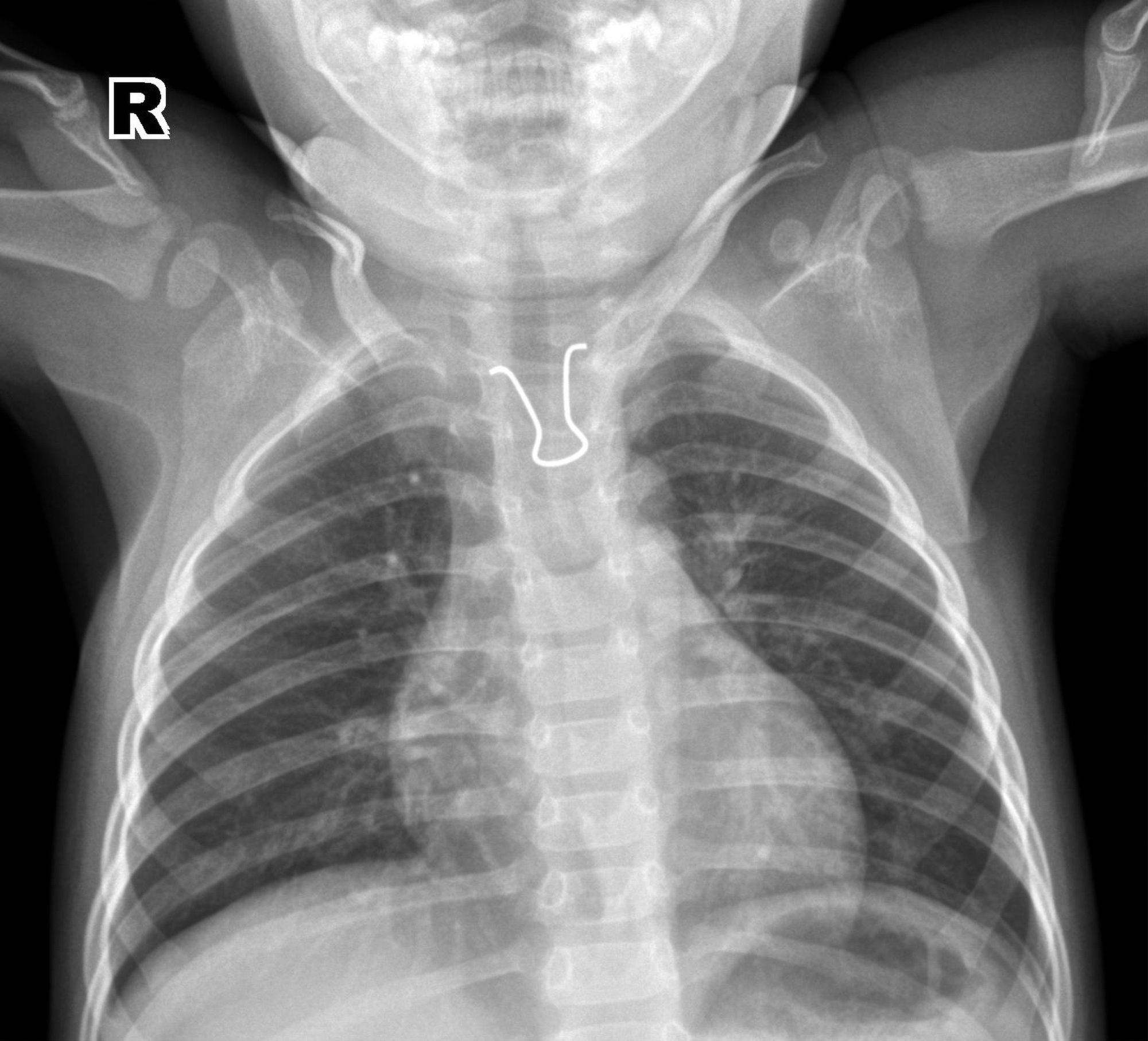 Read more about the article IRON DIET: XRay Shows Baby Had Swallowed Piece Of Binder Clip