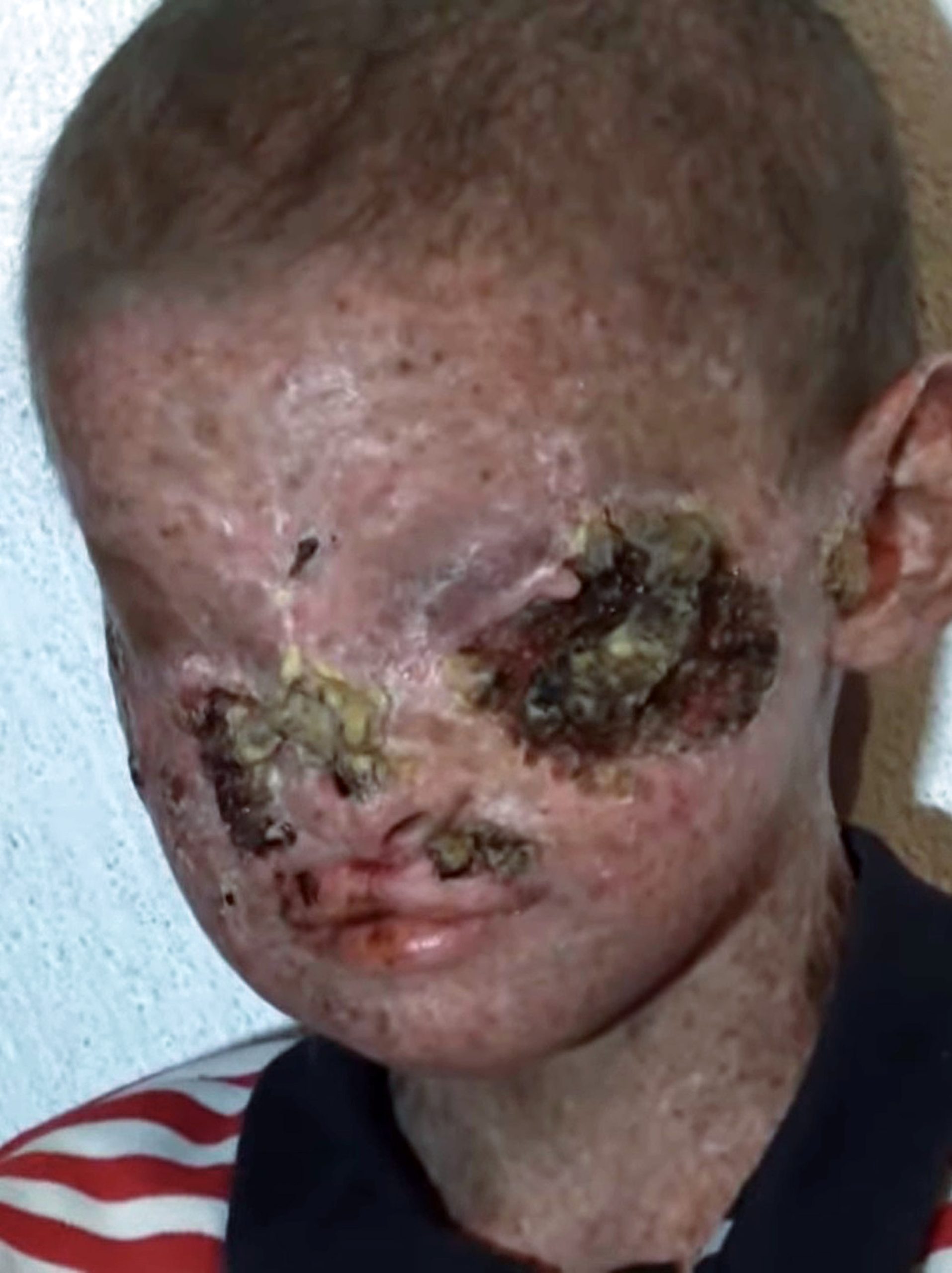 Read more about the article Hope For Boy, 11, Whose Skin Grew Over His Eyes Blinding Him After Skin Cancer Ate His Face