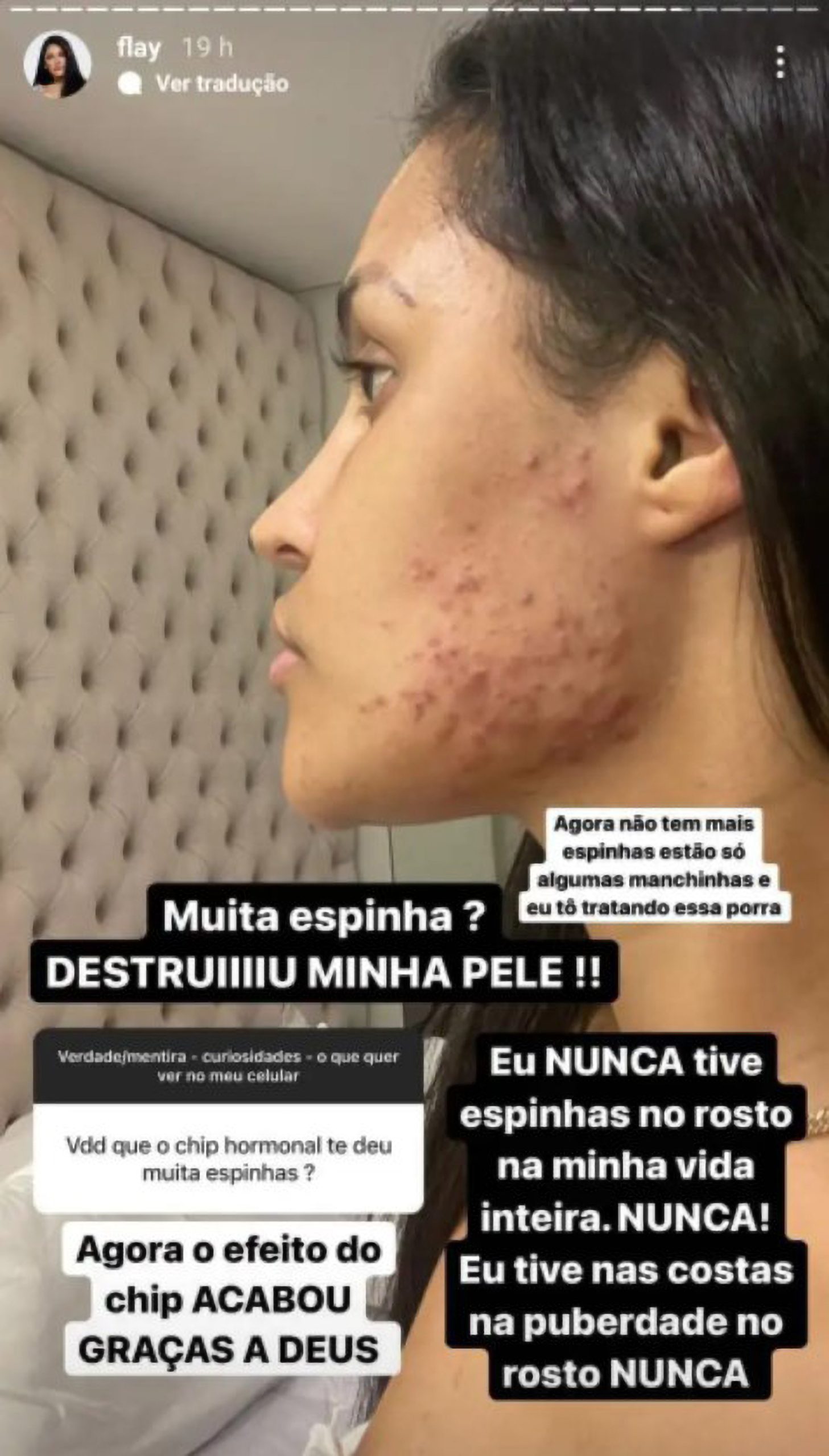 Read more about the article SPOT THE DIFFERENCE: Stunning Singer Claims Hormonal Chips Gave Her Acne