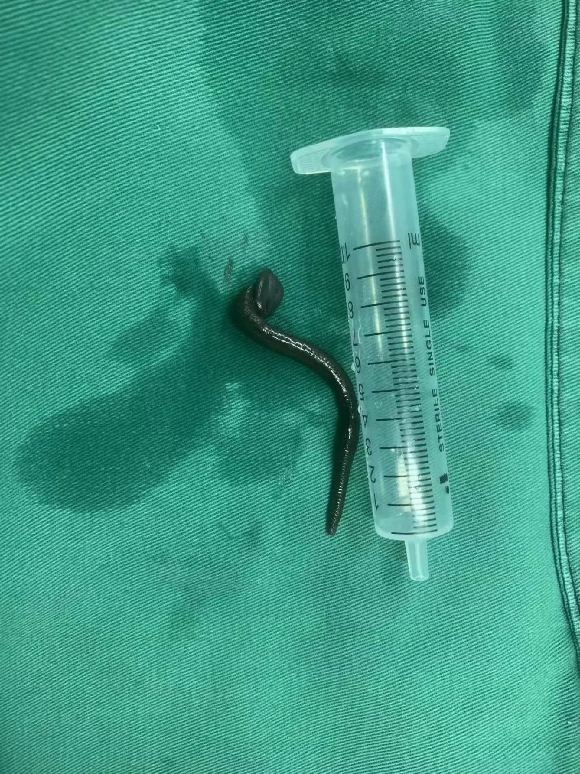 Read more about the article LEECH AWAY: Girl, 5, Has 15-Centimetre Leech Removed From Her Windpipe