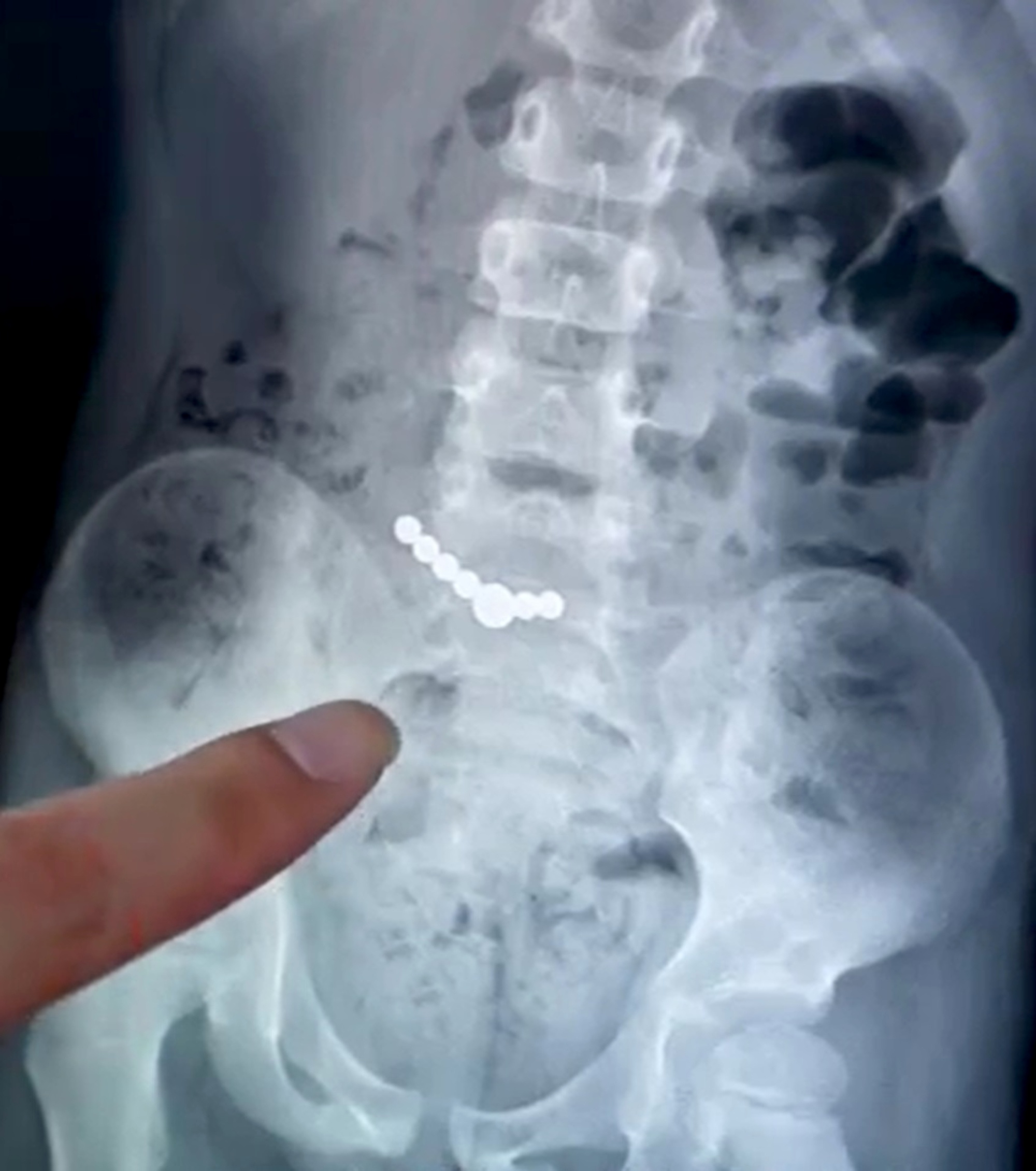 Read more about the article MAGNET AGONY: Five-Year-Old’s Bowel Burst By Magnetic Beads