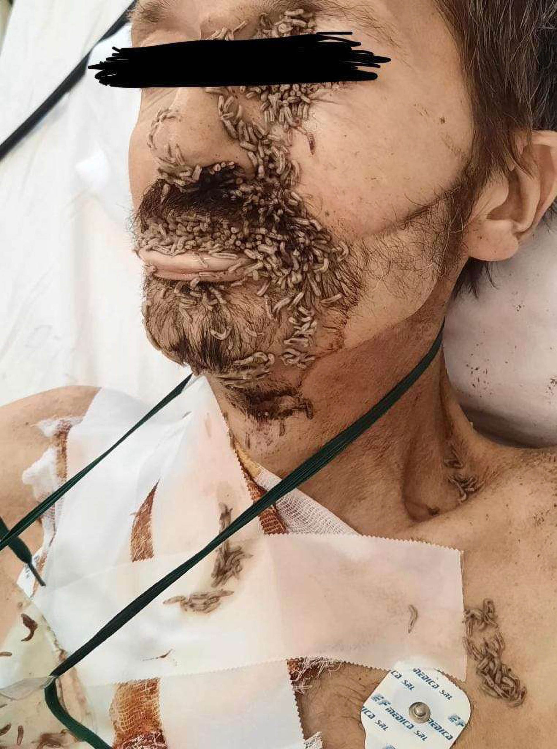 Read more about the article CHEW WON’T STOMACH THIS: Cancer Patient’s Face Eaten By Maggots