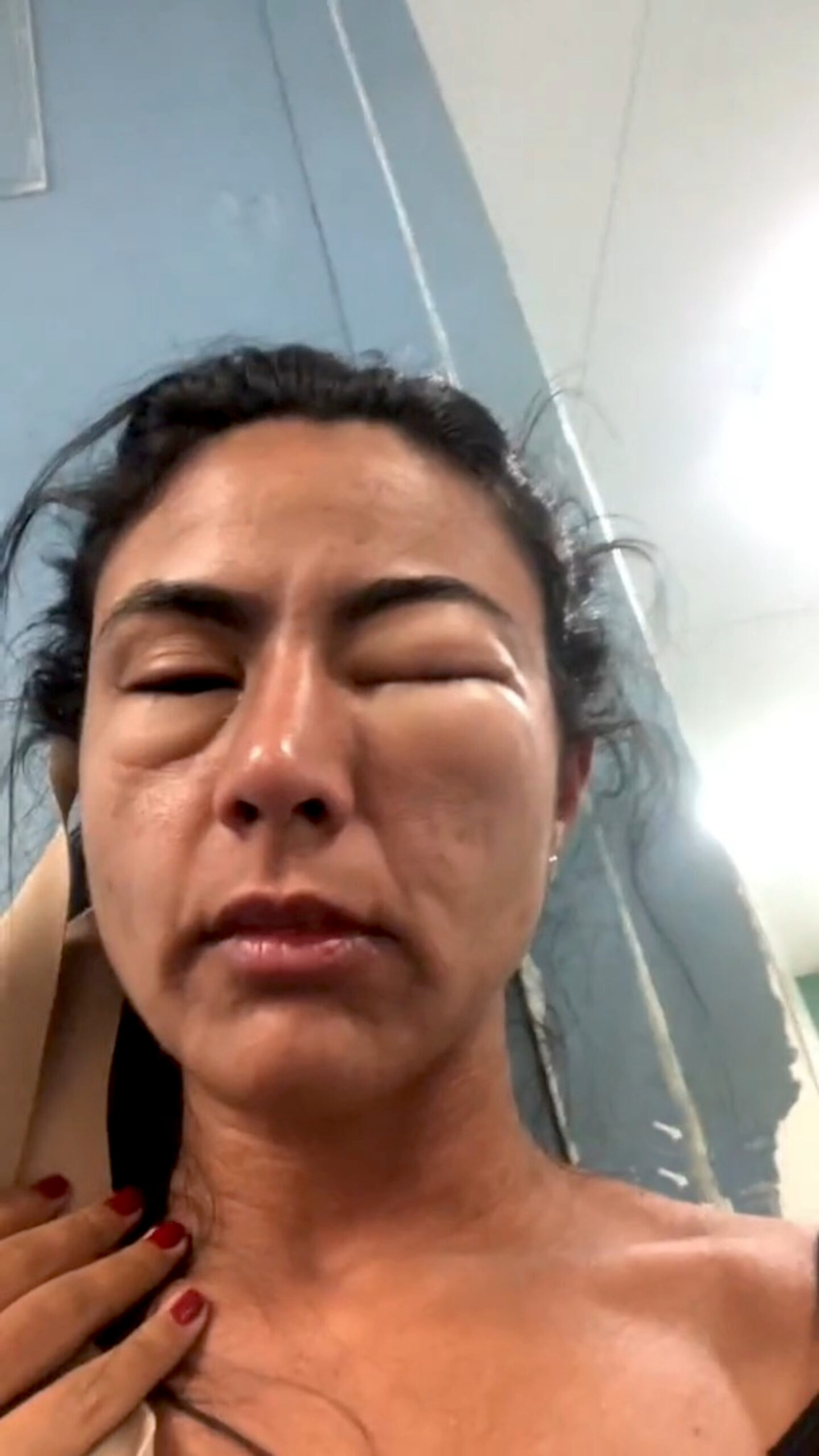 Read more about the article ALMOST KRILLED: Woman Left Looking Punched After Allergic Reaction To Prawns