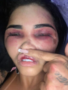 Read more about the article LIPO-RUCKTION: Influencer Left Swollen And Bruised in Attack By Ex-Husband