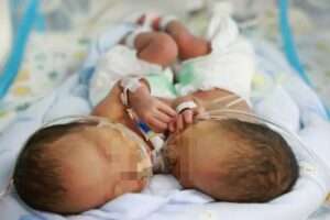 Read more about the article TWINCREDIBLE: Conjoined Twins Separated After Miracle Op