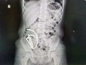 Read more about the article BALLS UP: Girl Who Swallowed 61 Magnetic Beads Has Intestines Perforated In 14 Places