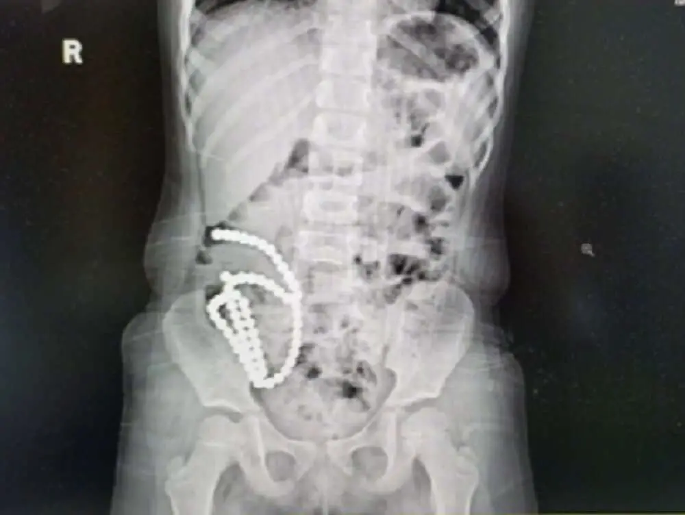 Read more about the article BALLS UP: Girl Who Swallowed 61 Magnetic Beads Has Intestines Perforated In 14 Places