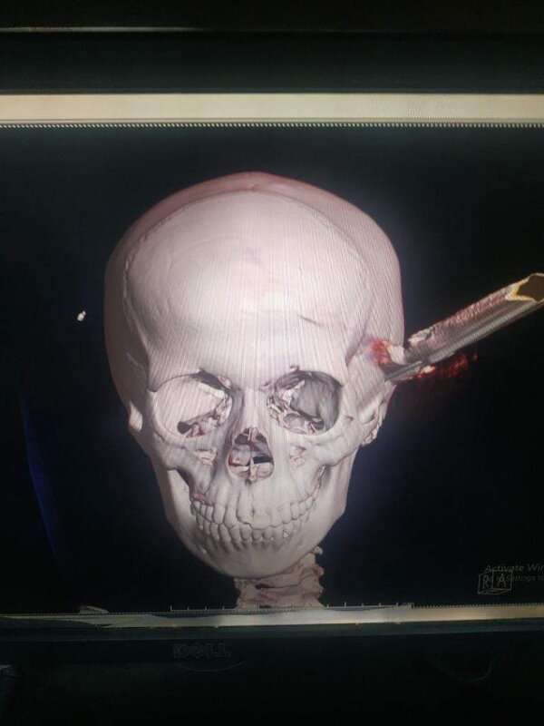 Read more about the article CRIME FILE: Schoolboy’s Skull Impaled On Metal Rasp
