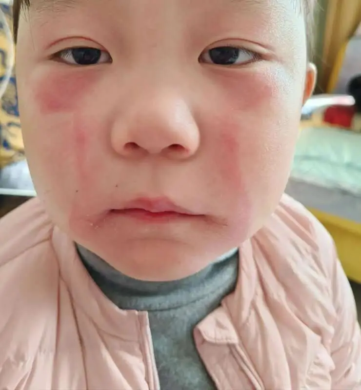 Read more about the article CRYING SHAME: Tot Is Allergic To Her Own Tears