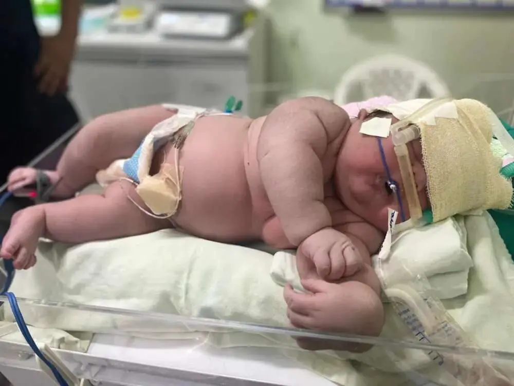 Read more about the article MAN BABY: 2ft 16lb Monster Tot Born In Brazil