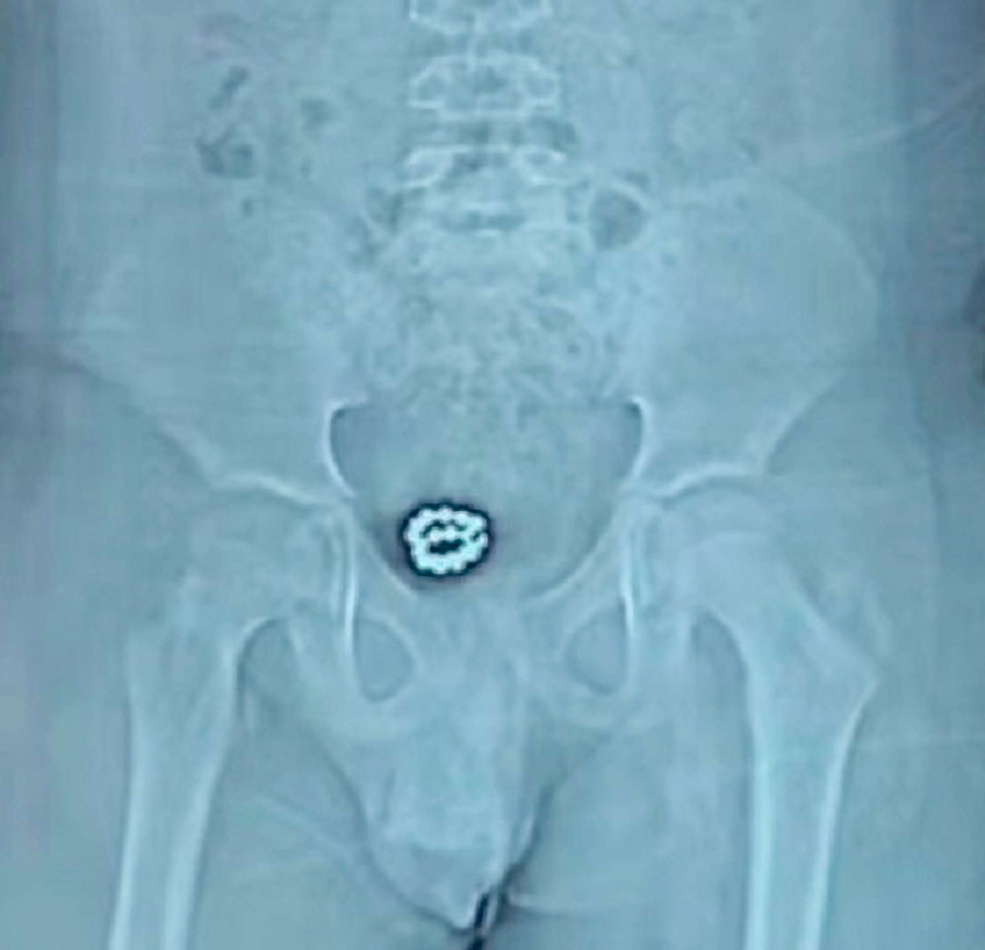 Read more about the article Agony Of Boy Who Had Stuffed Chain Of Magnetic Balls Up His Urethra