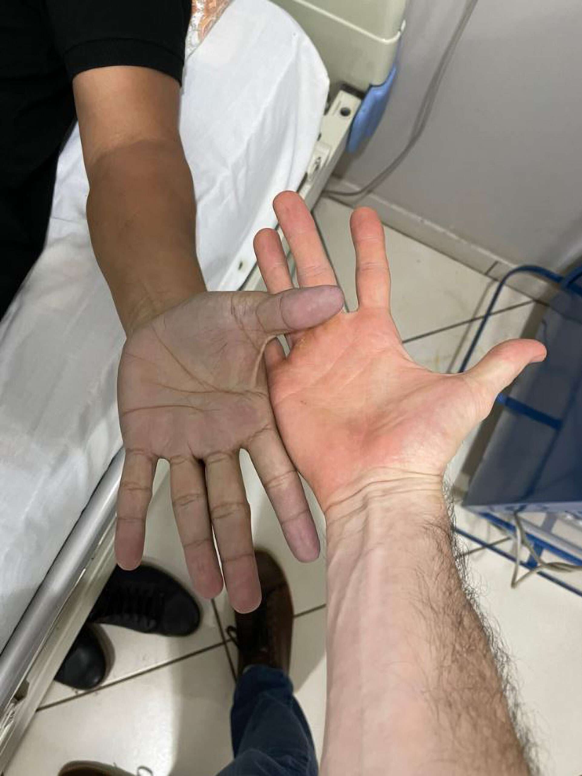 Read more about the article  ‘Am I Dye-ing, Doc?’ Asked Patient With Blue Hands