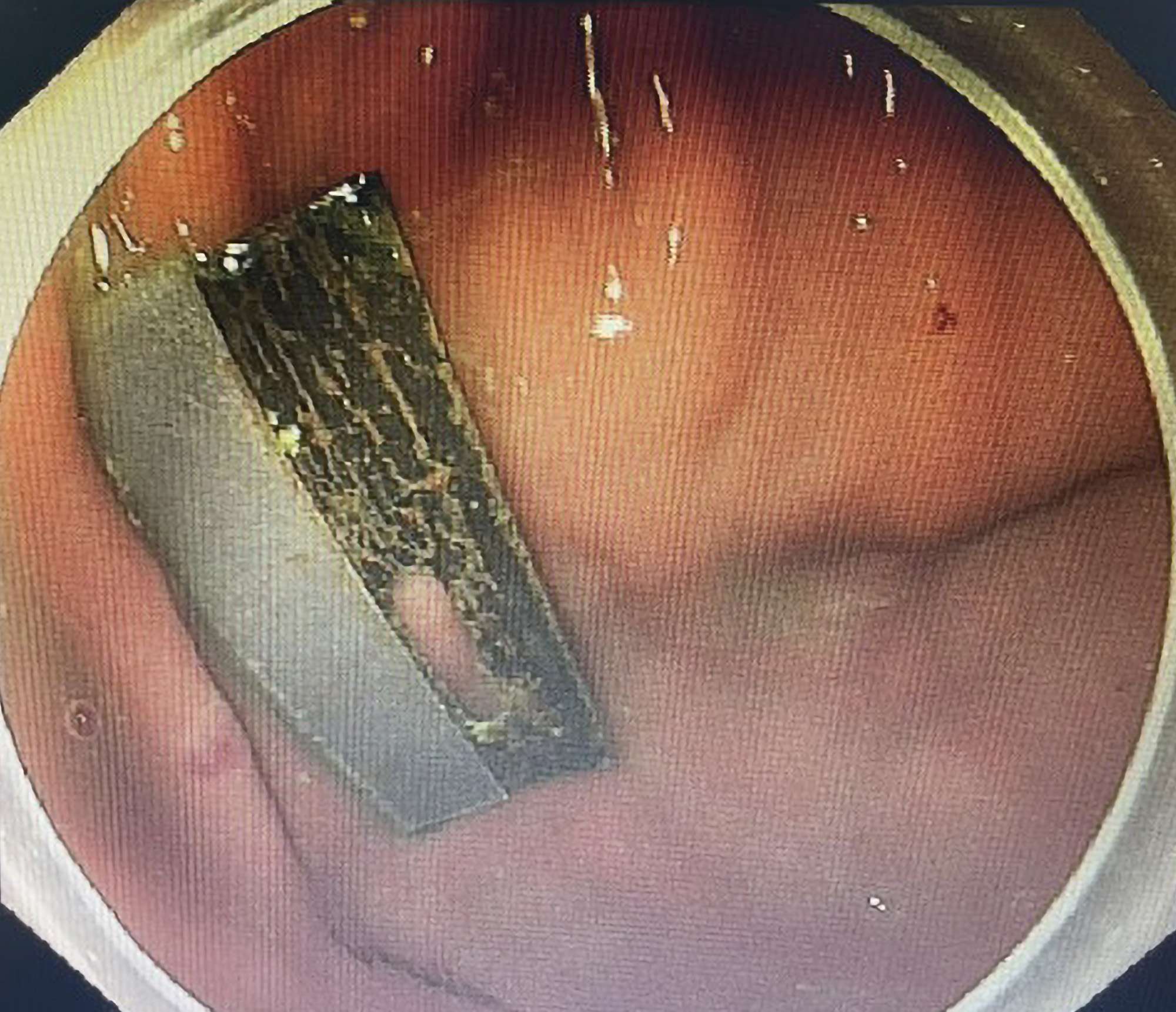 Read more about the article IT’S A WRAP: Doctors Use Condom To Remove Blade From Patient’s Stomach