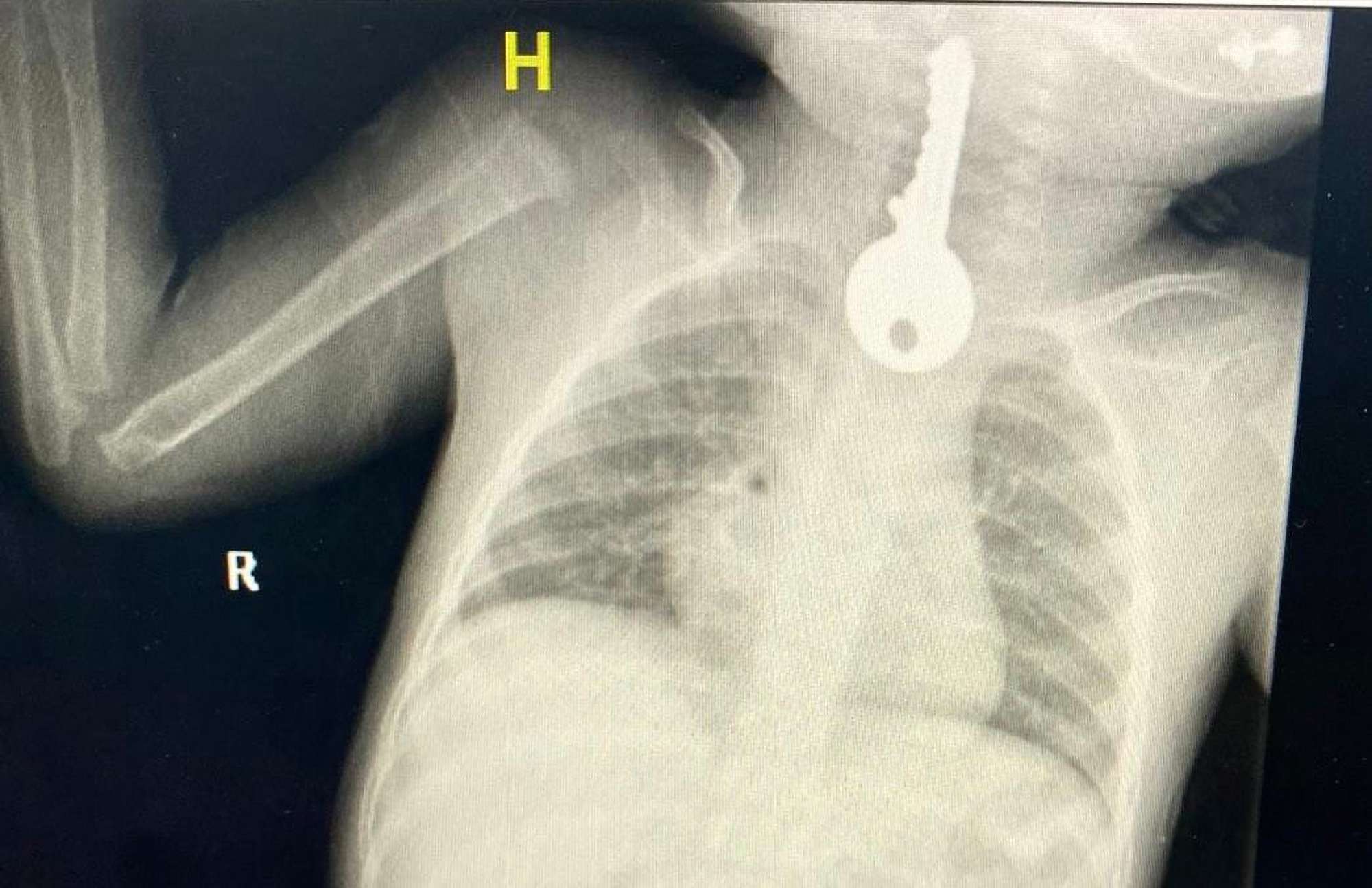 Read more about the article Young Boy Saved After He Swallowed Metal Key That Was Stuck In His Chest