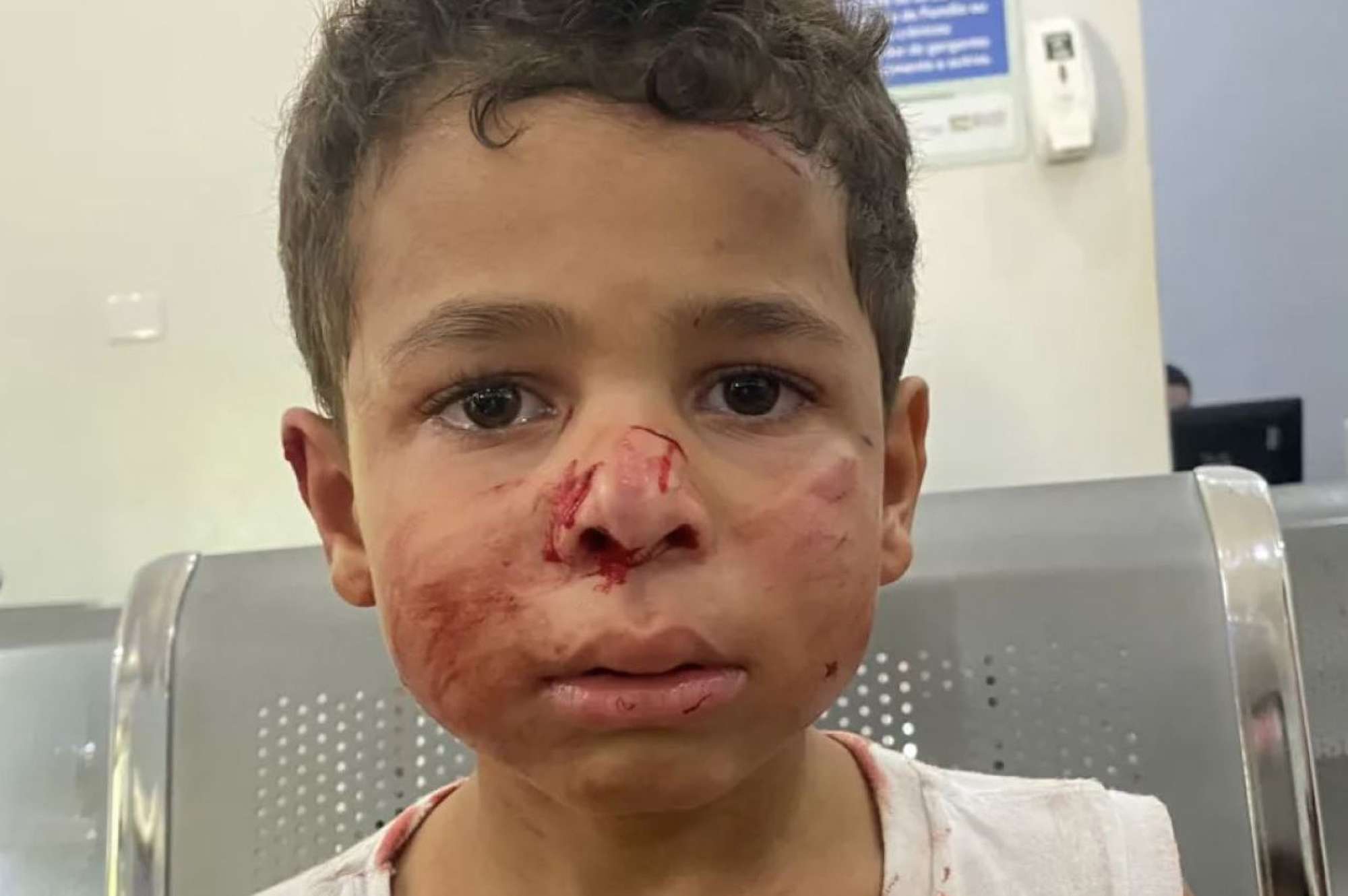 Read more about the article  Five-Year-Old’s Face Cut And Bloodied In Pit Bull Attack