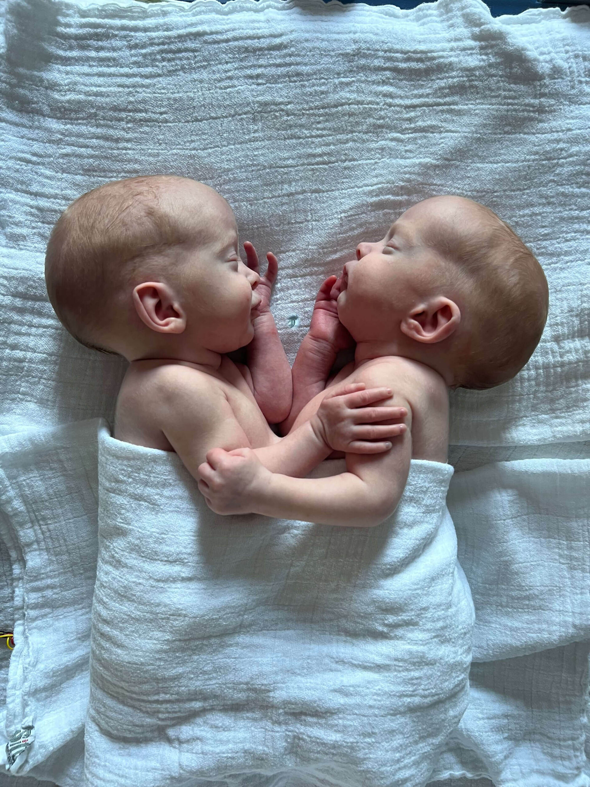 Read more about the article Conjoined Babies Successfully Separated In German Hospital