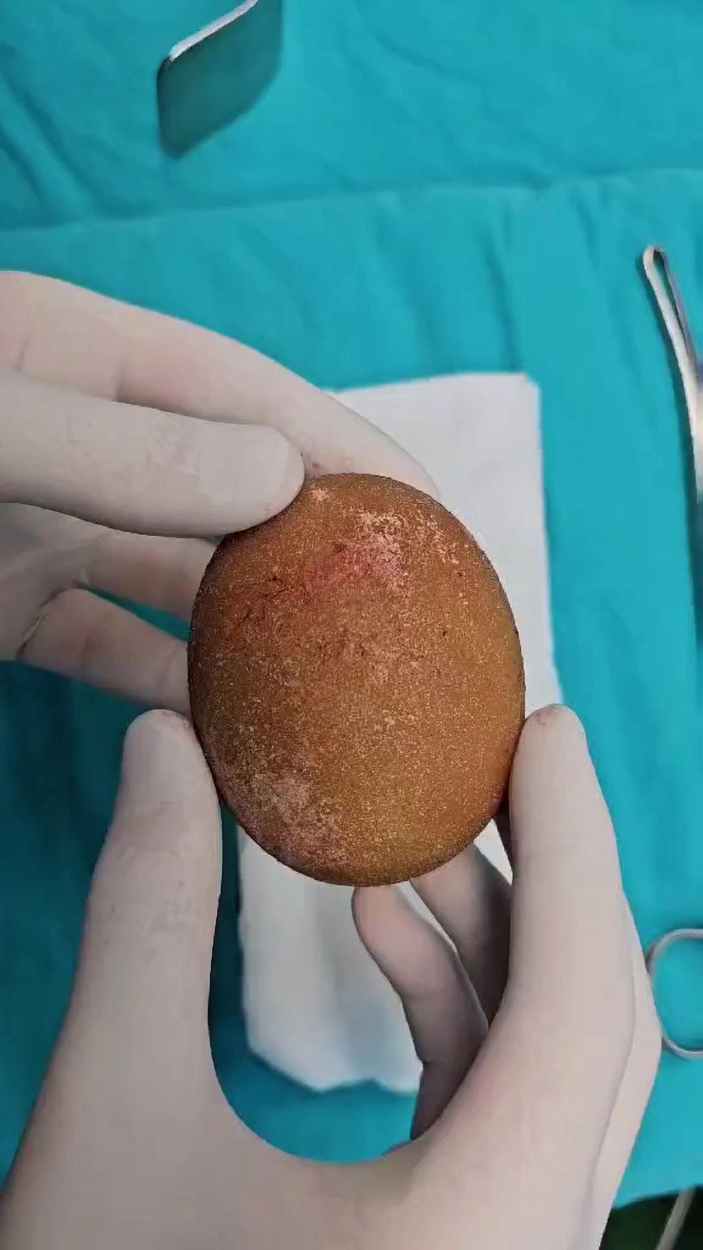Read more about the article Massive Egg-Shaped Stone Removed From Elderly Patient’s Bladder
