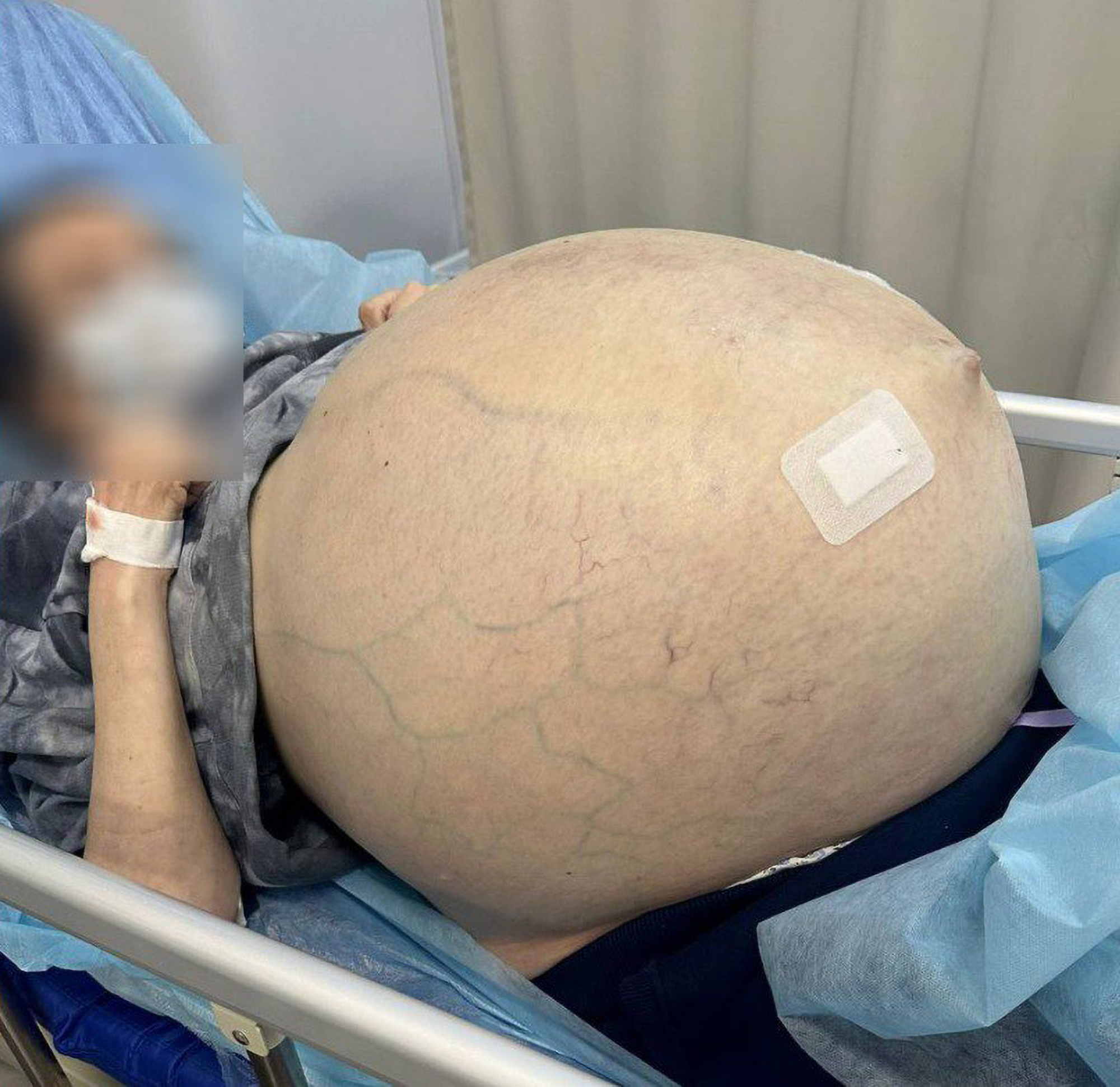 Read more about the article Woman Has Giant Ovarian Tumour Weighing 30 Kilogrammes Removed After Living With It For 10 Years